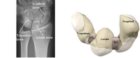 Scapholunate ligament injury - Melbourne Hand Surgery